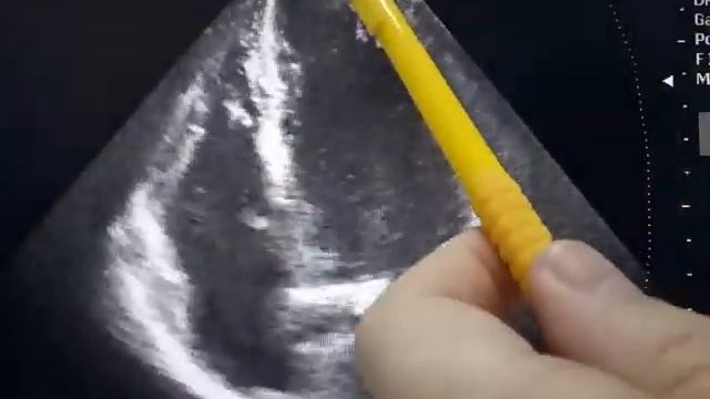 Апикальный гипокинез при сохранной фракции выброса смотреть онлайн