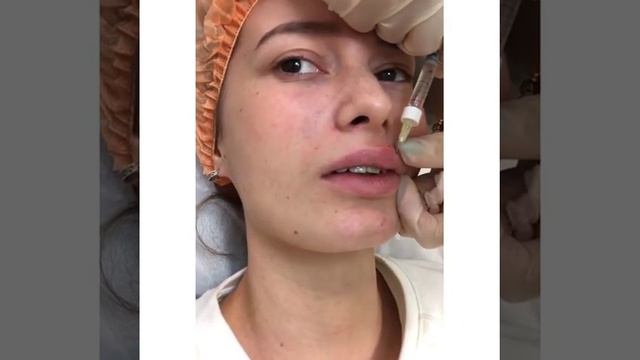 Увеличение Губ До После Клиника современной медицины "МедЭстет" смотреть онлайн