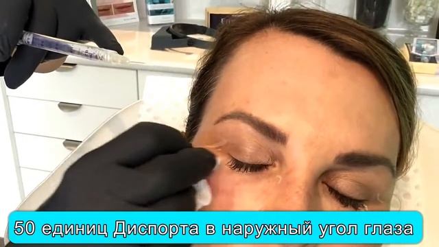 Диспорт в уголки глаз: 50 единиц, устраняем гусиные лапки