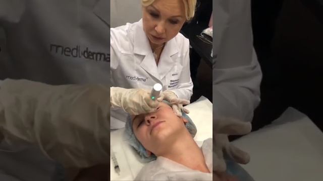 Сочетание в одной процедуре химического пилинга и фракционной мезотерапии