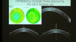 Сравнение геометрии роговичных лоскутов. Баталина Л.В. (Клиника «Эксимер», г. Москва)