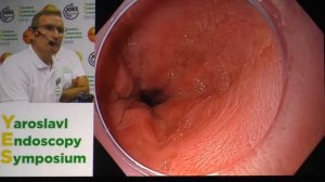 20Live Пищевод Барретта С4М6 увеличительная эндоскопия