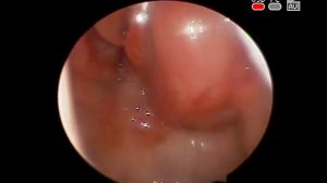 #Киста (сумка) Торнвальда - образование #носоглотки #ЛОР диагностика КЛИНИКА ОБРАЗЦОВА