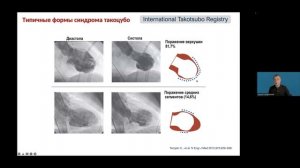 Гиляревский С.Р. Острая коронарная недостаточность.mp4