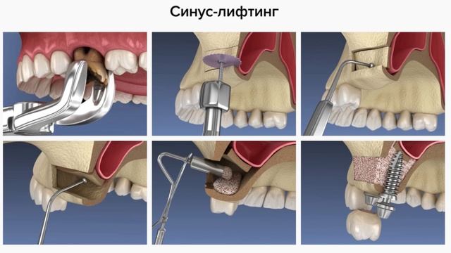 ? Синус-лифтинг