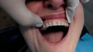 Протезирование пациентки "К" нейлоновым протезом.  4- я стоматология.