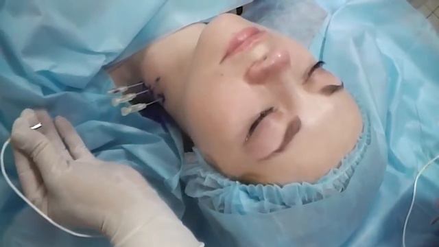 Лечение позвоночника. Шея. Радиочастотная нейромодуляция.