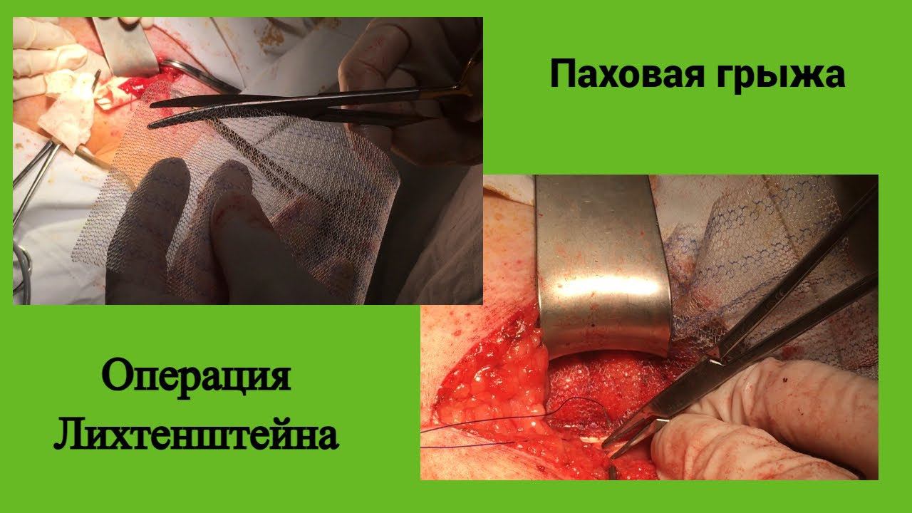 Паховая грыжа  Операция Лихтенштейна