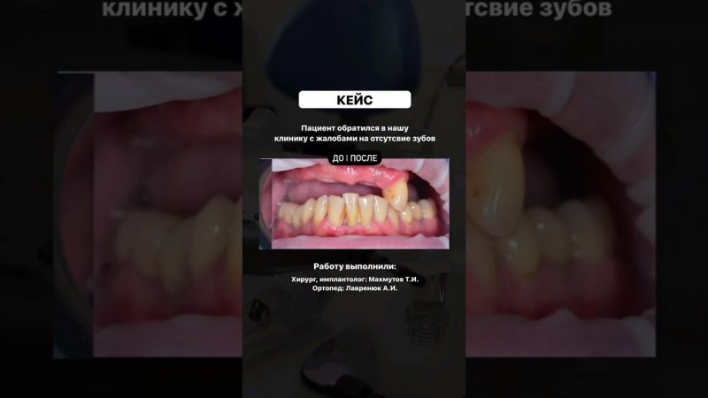 Кейс протезирование с опорой на импланты Straumann  #shots #протезированиезубов #имплантациязубов
