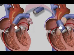 Операция Росса (для профессионалов) - одна из самых красивейших операций при пороке клапана аорты.