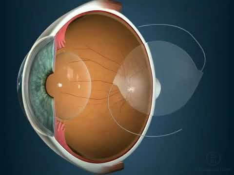 Мультифокальные линзы