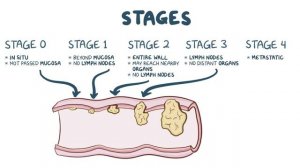 Colorectal carcinoma - causes, symptoms, diagnosis, treatment, pathology