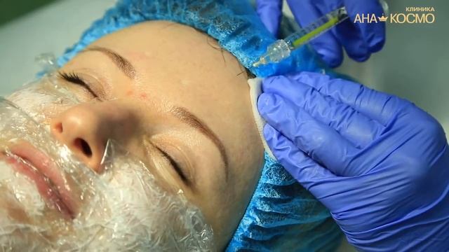 Как убрать морщины на лице ✦ Филлер Белотеро✦ Бланшинг➤ смотреть онлайн