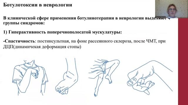 Ботулотоксин. Его применение в неврологии. Иванова Лариса Борисовна. смотреть онлайн