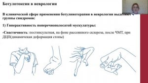 Ботулотоксин.  Его применение в неврологии.  Иванова Лариса Борисовна.