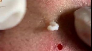 Удаление черных точек 2021 - Remoção de cera de ouvido 2022 EP006