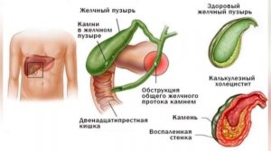 Камни в жёлчном пузыре !Снять колику в области желчного пузыря!