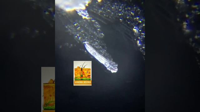 Демодекс, клещ на ресницах смотреть онлайн