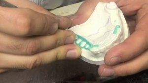 Бюгельный протез, моделировка каркаса