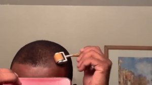 Путешествие по восстановлению роста волос № 2 (миноксидил + мезороллер)