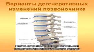 Дегенеративные изменения менисков