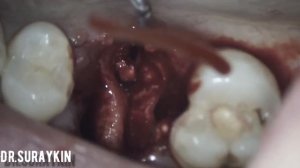 Удаление зуба , вырвать зуб , на приеме у стоматолога , пошли к стоматологу , киста в зубе .