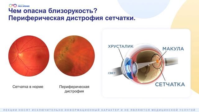 Чем опасна близорукость?