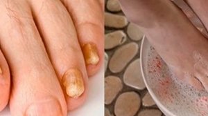 Как размягчить ногти