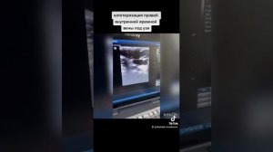 Катетеризация внутренней яремной вены справа под узи навигацией