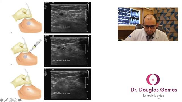 Todo cisto da mama precisa ser puncionado? смотреть онлайн