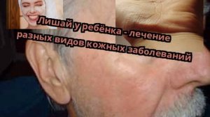 Лишай у ребёнка - лечение разных видов кожных заболеваний