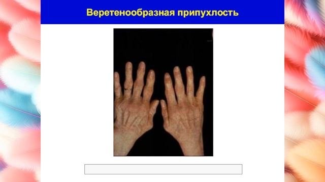 Почему деформируются суставы рук? Шишки и узлы на руках.