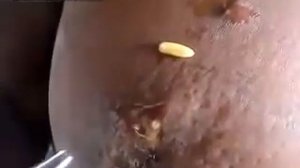 Паразиты. Личинки овода извлекли из женской груди Botfly Larvae Removed from Woman's Breast