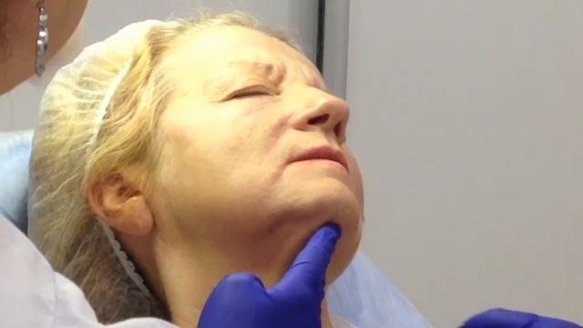 Аириском; обучение косметологии. Студенты практикуют. Носогубная складка, губы 24ХР смотреть онлайн