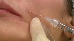 Гибкие тупоконечные иглы (канюли) SOFTFIL