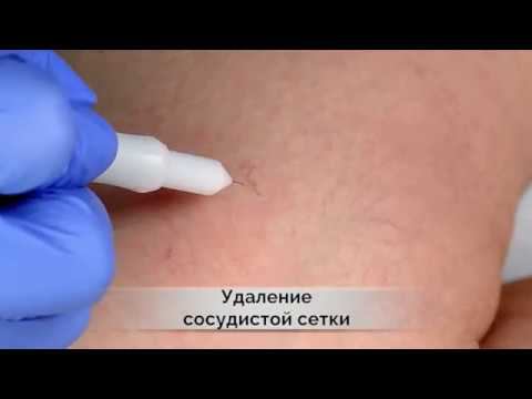 Удаление сосудистой сетки