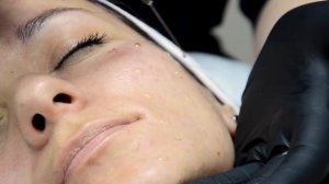 Процедура пилинг PRX-33