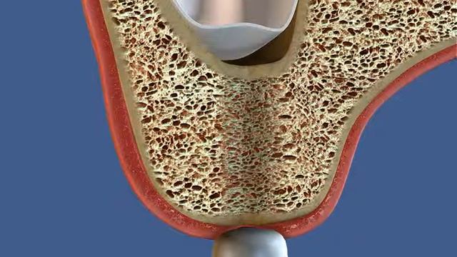 Закрытый синус лифт через мукотом смотреть онлайн