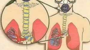 Баротравма легкого