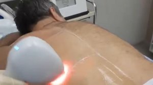 Лазерная эпиляция спины диодным лазером