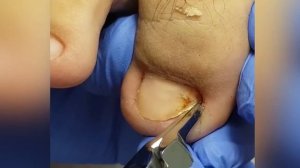 Вросший ноготь????.mp4