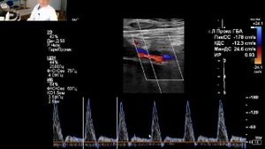 УЗИ сосудов нижних конечностей. Разбор.