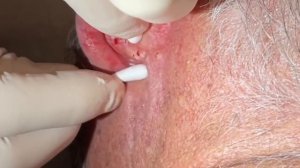 Ear Blackhead extractions. Multiple techniques used for deep embedded dry plugs and cyst pops.