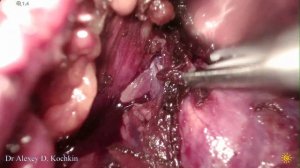 Not for beginners lap partial nephrectomy/лапароскопическая резекция почки Кочкин