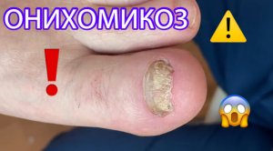 Онихомикоз ?⚠️❗️??