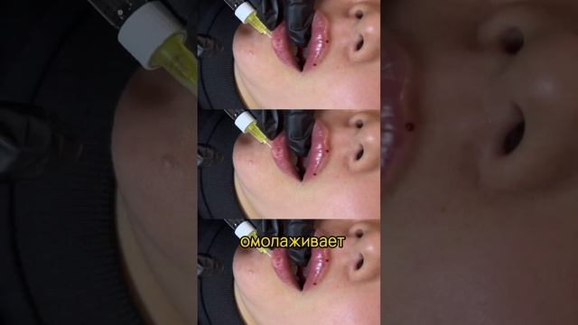 Контурная пластика губ смотреть онлайн