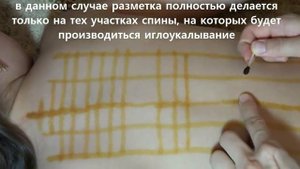 Акупунктура.Постановка игл на спину. www.acupuncture.uz
