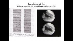 Рогатова А.Н. "ЭКГ при ИБС" Часть 2 (27.10.2023)