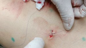 Липоматоз  Удаление липом скальпелем № 11