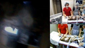 установка гастростомы